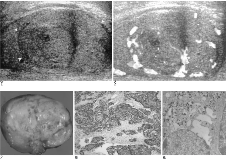 Fig. 1. A 50-year-old man with a primary carcinoid tumor of the testis.