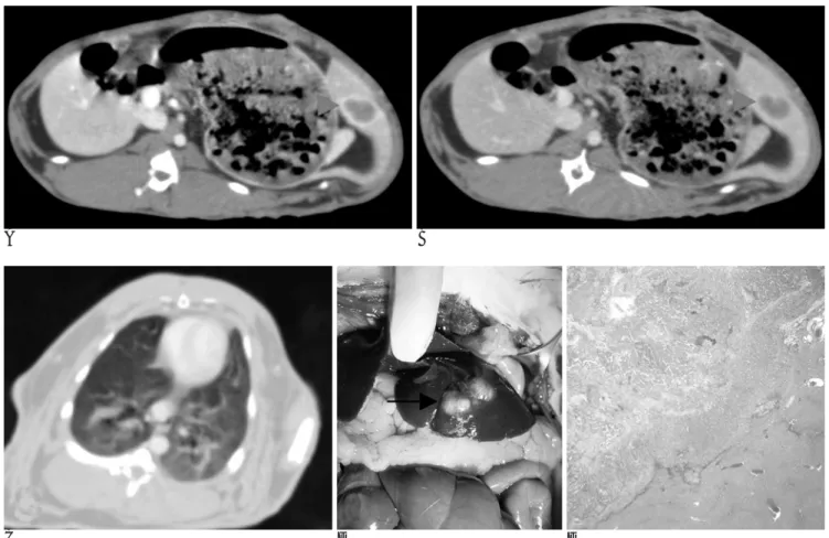 Fig. 2. Successful inoculation of VX2 tumor particles into the hepatic parenchyma. Contrast enhanced CT of 10 seconds (A) and 60 seconds (B) delayed scans demonstrate typical VX2 tumor(arrowhead) appearance which shows peripheral enhancement with  cen-tral