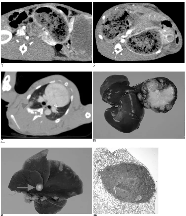 Fig. 7. Tumor metastasis.