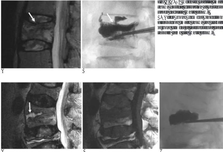 Fig. 3. A. T2 weighted sagittal image shows dark signal intensity line rimmed cystic area (white arrow) in vertebral body