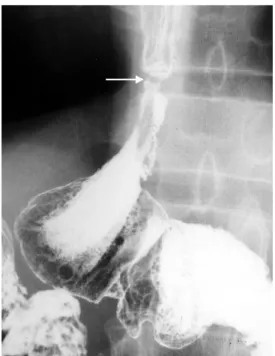 Fig. 3. The one-week follow-up esophagography demonstrates good patency of the anastomotic lumen and no further barium leakage.