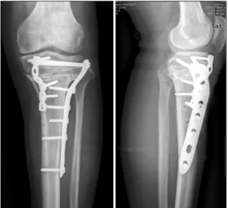 Fig.  4. Four  months after the corrective  osteotomy,  radiographs show  the  correction  of  genu  recurvatum  and  genu  varum