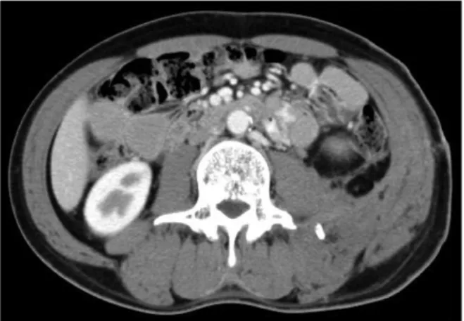 Fig.  5.  Control  computed  tomography  scan  at  the  level  of  the  third  lumbar  vertebrae  3  months  after  embolization  shows  a  markedly  decreased  retroperitoneal  hematoma.