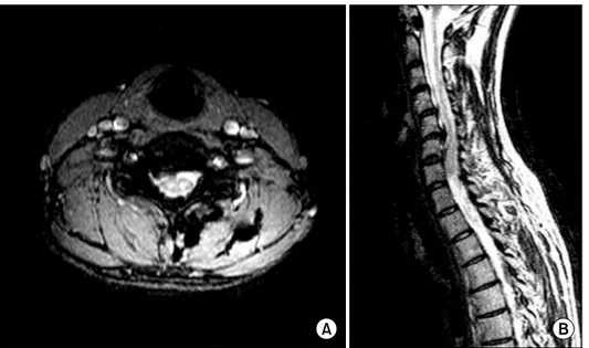 Fig.  1.  T2  axial  (A)  and  sagittal (B)  MRI  images  showing   com-pression  of  right  6th  cervical  nerve  by  a  hard  disc  (Case  1).