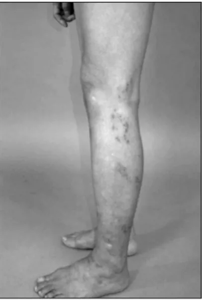 Fig.  3.  Clusters  of  erythematous  papules  in  L5  and  S1  der- der-matomes  of  left  leg  (Case  2).