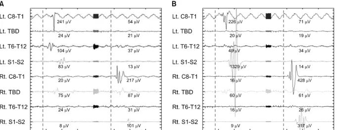 Fig.  1.  (A)  Normal  muscular  response  by  motor  evoked  potential  (MEP)  stimulus  at  70  mA  before  pedicle  screw  placement