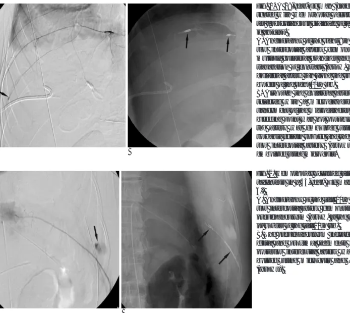 Fig. 2. Hemothorax occurred after tho- tho-racentesis in a 54-year- old man (case 6). 