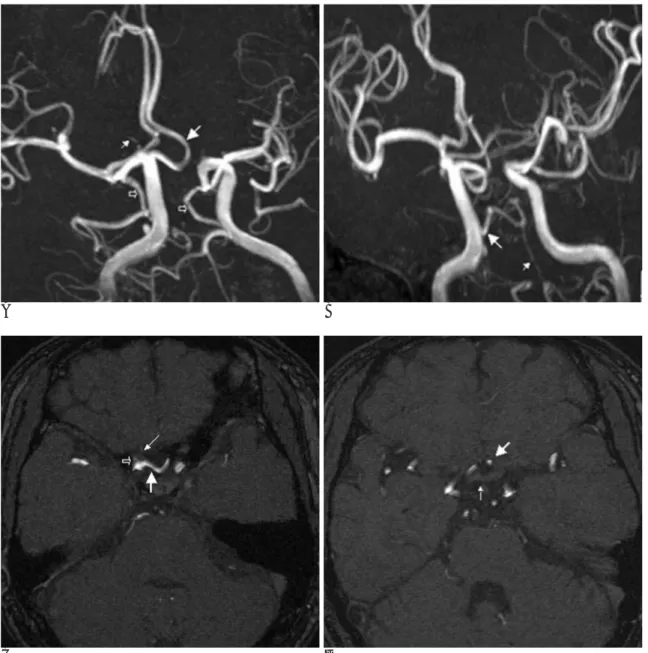 Fig. 1. A-D. Angiographic (A, B) and source images of a 3D TOF MR angiography (C, D). The left anterior cerebral artery (large ar- ar-row, A) is arising from the right ICA at the origin of the ophthalmic artery (small arar-row, A)