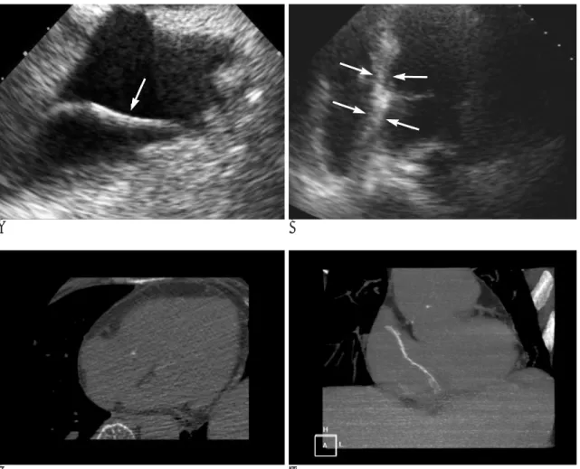 Fig. 1. A 60-year-old woman with an intracardiac foreign body from bone cement material migrated into the right cardiac chamber following THR.