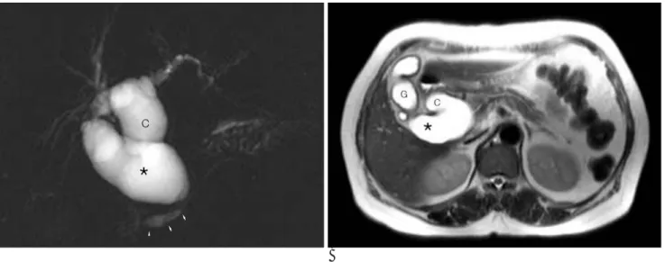 Fig. 1. A 66-year-old man presented with right upper quadrant abdominal pain for 2 months