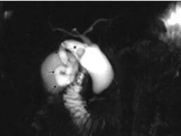 Fig. 2. A 56-year-old man presented with right upper abdomi- abdomi-nal pain for a month.