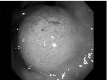 Fig. 1. Gastroscopic finding of primary adenosquamous carci- carci-noma of the stomach