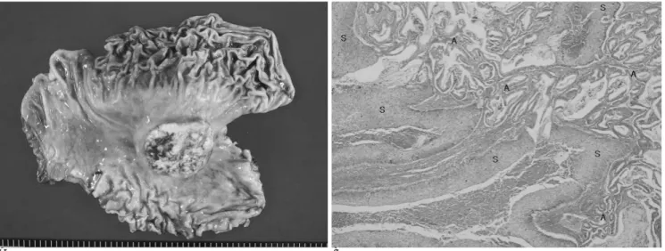 Fig. 3. Pathologic findings of primary adenosquamous carcinoma of the stomach.