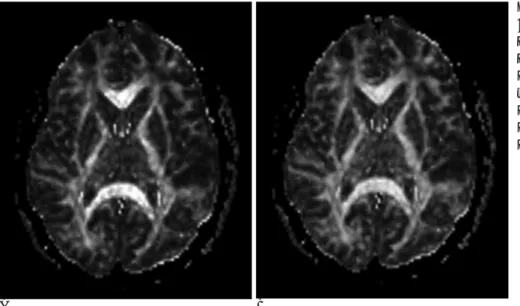 Fig. 4. Diffusion tensor MR images in 12-year-old health boy. Relative anisotropy map (A) and Fractional anisotropy map (B) describe degree of diffusion anisotropy in each voxel