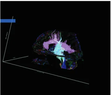 Fig. 6. Diffusion tensor MR image in 44-year-old health woman. Three dimensional fiber tracts are generated on basis of fractional anisotropy by line propagation technique.