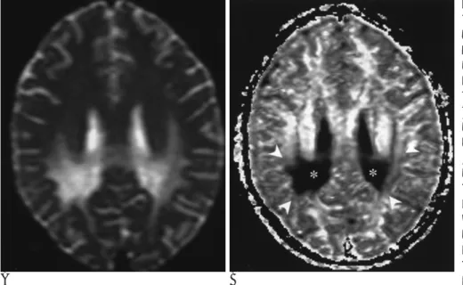 Fig. 9. 9-year-old boy with cerebral X- X-linked adrenoleukodystrophy (ALD) who presented with progressive motor and visual deficits