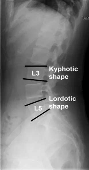 Fig.  1.  Method  of  measuring  sagittal  shape  of  the  body  at  standing  lateral  view.