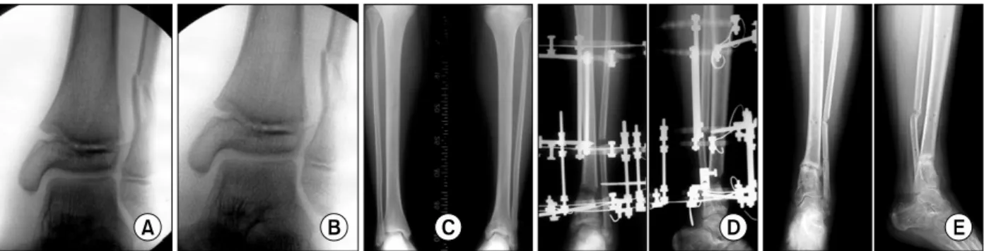 Fig.  1.  A  11-year-old  girl  left  distal  tibia  physeal  injury  was  treated  with  closed  reduction  and  cast