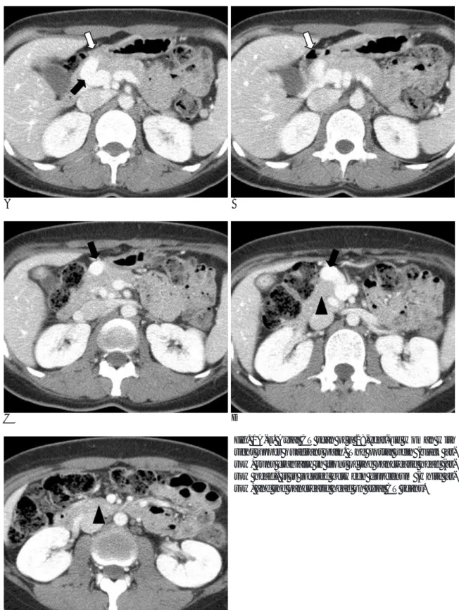 Fig. 1A-E. Axial CT scan of a 28-year-old woman with right upper quadrant pain. The portal vein (black  ar-row) runs cranially in front of the pancreatic head  (row head)