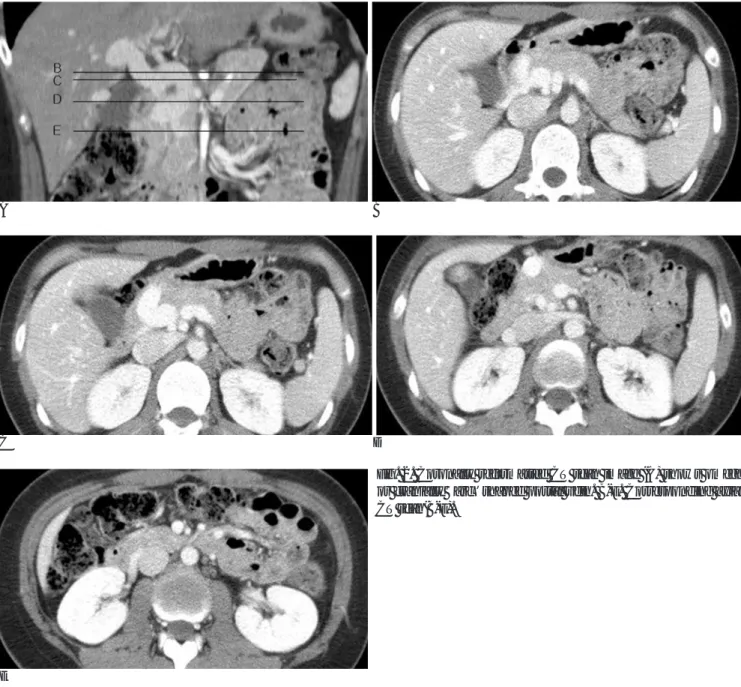 Fig. 2. Coronally reformatted CT scan image (A) shows omega or cranially  ‘arc’shaped portal vein