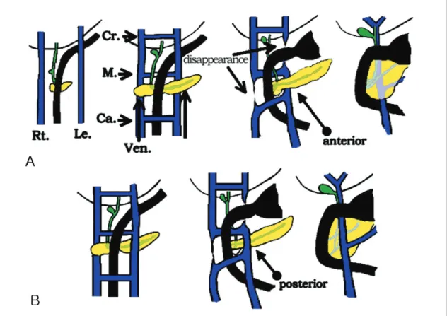 Fig. 4. Schematic diagram of the hypothesis of Hashimoto et al of normal embryological development of the portal vein (A), and hy- hy-pothesis of Matsumoto et al