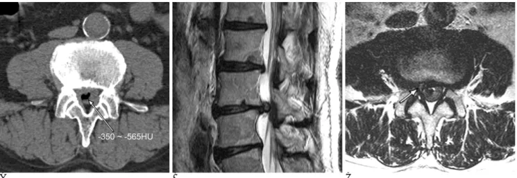 Fig. 1. L3-4 intradural disc herniation. 