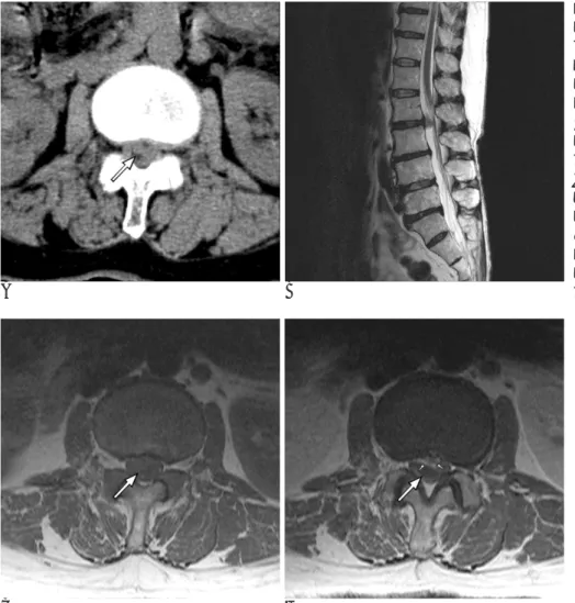 Fig. 3. L2-3 intradural disc hernia- hernia-tion. 