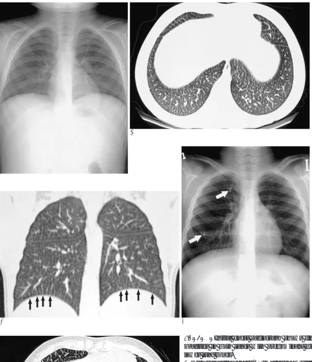 Fig.  1.  A. Initial chest radiograph shows fine reticulonodular opacities in both lungs with predominant distribution in both lower lung zones.