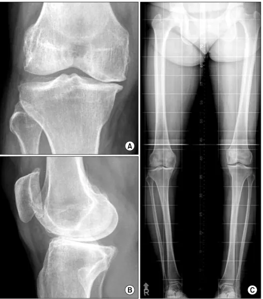 Fig.  3.  Preoperative  radio- radio-graphs of fifty five-year-old  wo-man with symptomatic  degene-rative  osteoarthritis  on  right  knee