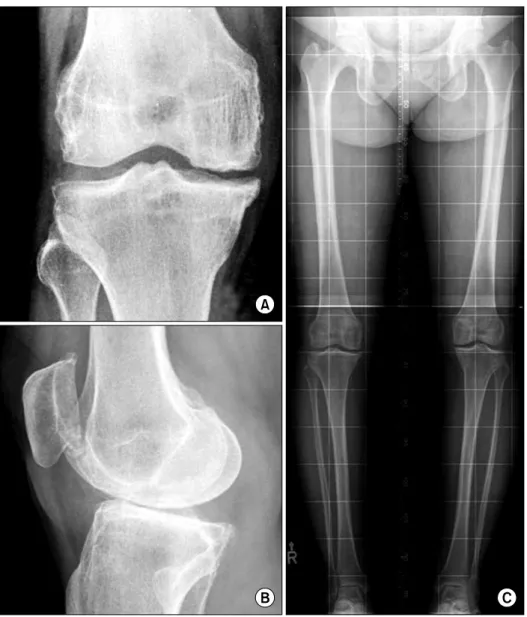 Fig.  4.  Radiographs  4  years  after  microfracture  of  fifty  five-  year-old  woman  with   sympto-matic  degenerative   osteoar-thritis on right  knee