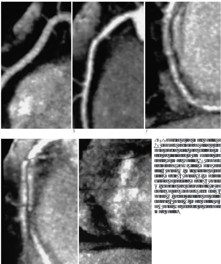 Fig. 1. Grading of the image quality of CT coronary angiography using a five point grading scale