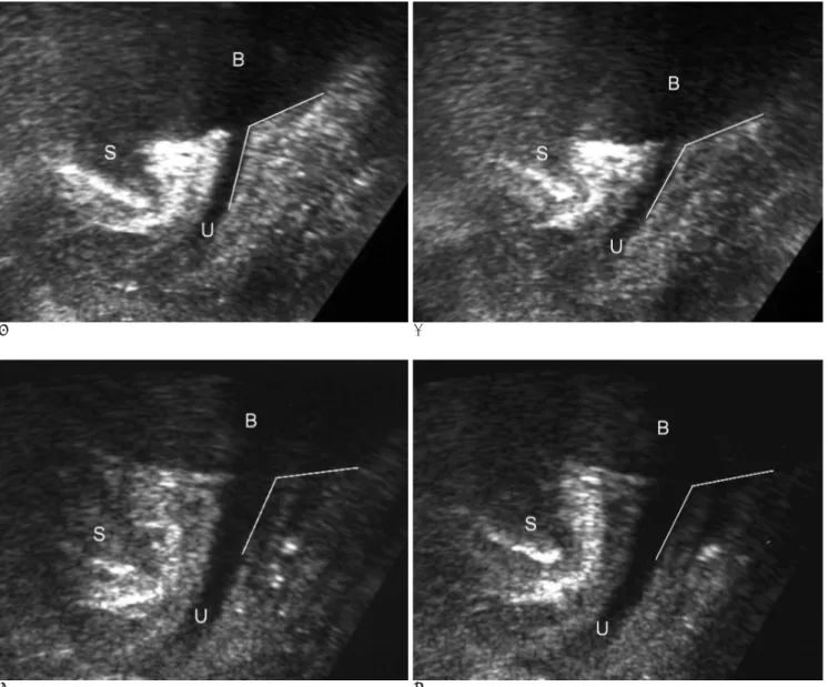 Fig. 3. A 41-year old woman with stress urinary incontinence. 