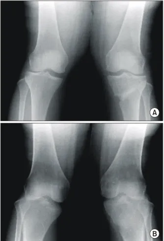 Fig. 3. At postoperative 2.5 years, 0 o  (A) and 30 o  (B) valgus stress view  does  not  show  a  significant  difference,  when  compared  with the  opposite  side