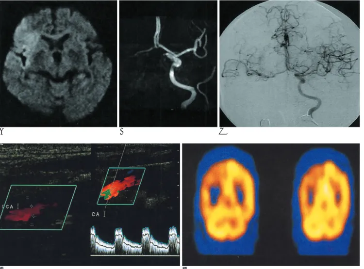 Fig. 2. 56-years-old man showing pattern I on the brain MRI. Diffusion weighted image (A) shows infarction in the right MCA terri- terri-tory