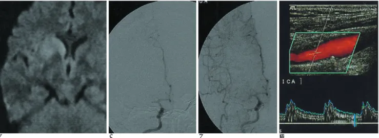 Fig. 3. 67-years-old woman shows the increased signal intensity on the right lentiform nucleus on the diffusion weighted image (A).
