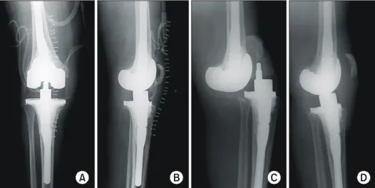 Fig. 2. The  patient  showed  extension  lag  90 o   preoperatively.