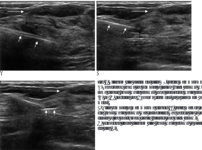 Fig. 2. Titanium clip placement after US-guided mammotome biopsy.