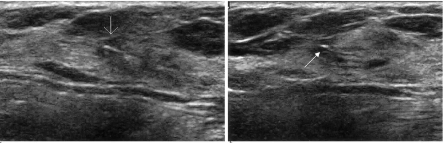 Fig. 4. Follow-up sonogram after 6-months reveal echogenic titanium clip within the hypoechoic scar on transverse (A) and longitu- longitu-dinal (B) scans on 6-month follow-up sonography.