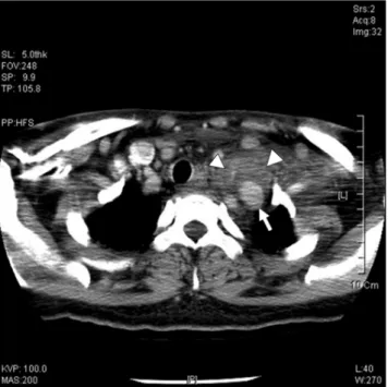 Fig. 3. A. An echolucent mass with thrombus adjacent to the left subclavian artery and the neck of  pseudoa-neurysm (arrow) are seen