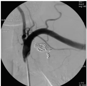 Fig. 5. Left subclavian angiogram after embolization shows complete occlusion of the pseudoaneurysm with coils.