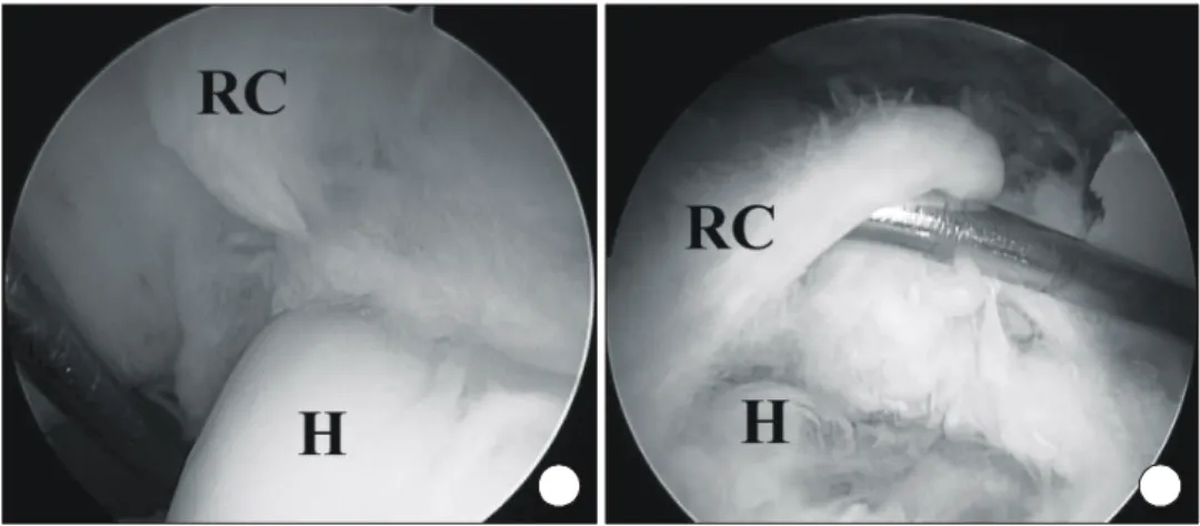 Fig. 4. Arthroscopic image showing fragmentation on the bursal side  of  the  rotator  cuff