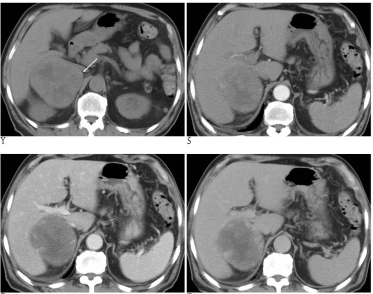 Fig. 1. A 76-year-old man with adrenal cavernous hemangioma.