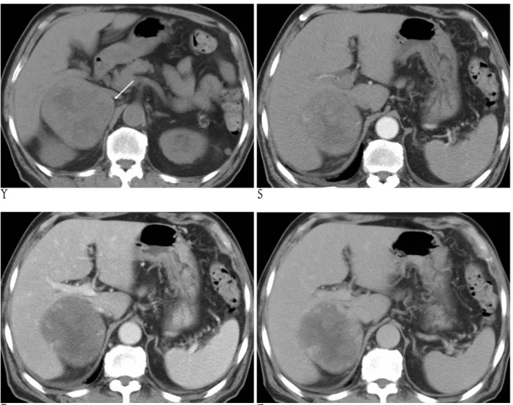 Fig. 1. A 76-year-old man with adrenal cavernous hemangioma.