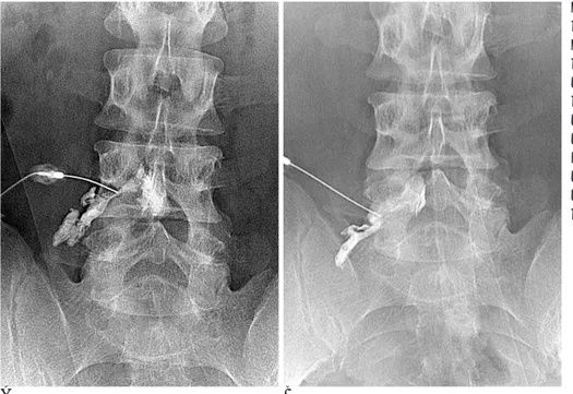 Fig. 2. A 38-year-old-man with pain in low back and left anterior thigh.