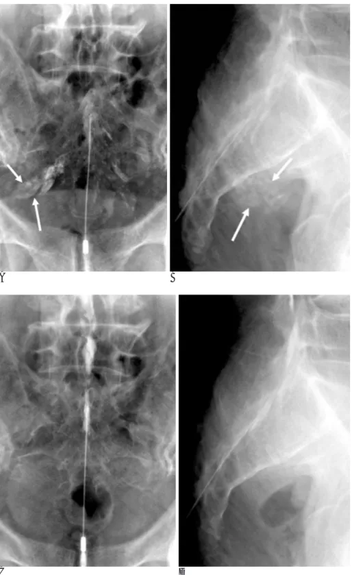 Fig. 4. A 74-year-old man with low back pain. At his first visit, we  per-formed caudal epidural block