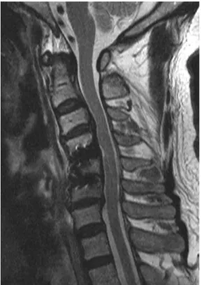 Fig. 4. Dural opening (arrow) is observed on the surgical pho- pho-tograph.