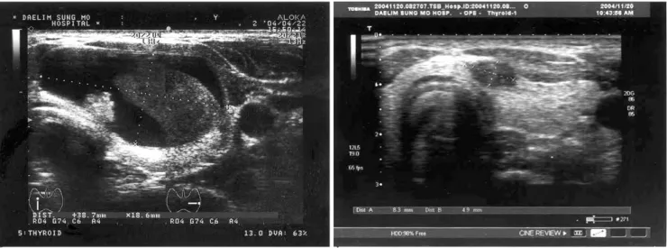Fig. 1. A 28 year-old man with recurrent hemorrhagic nodule. 