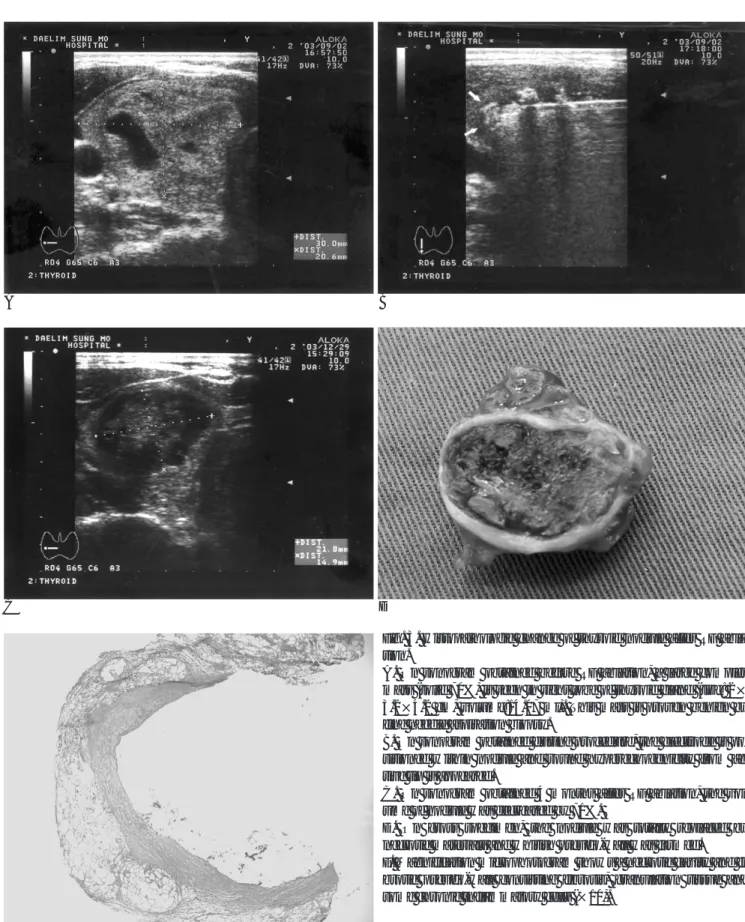Fig. 3. Histopathologic change of thyroid nodule after RF abla- abla-tion.