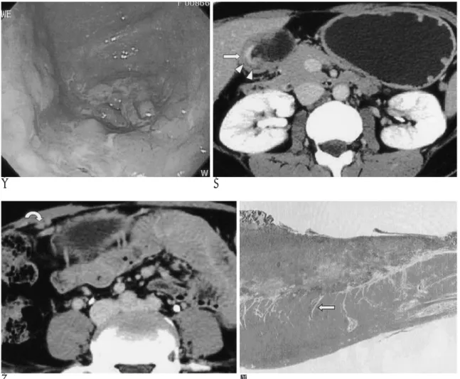 Fig. 1. Small advanced gastric cancer in a 40 year-old-man. 