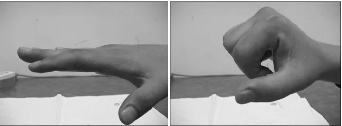 Fig.  7.  Gross  photograph  about  the  range  of  PIP  joint  motion.